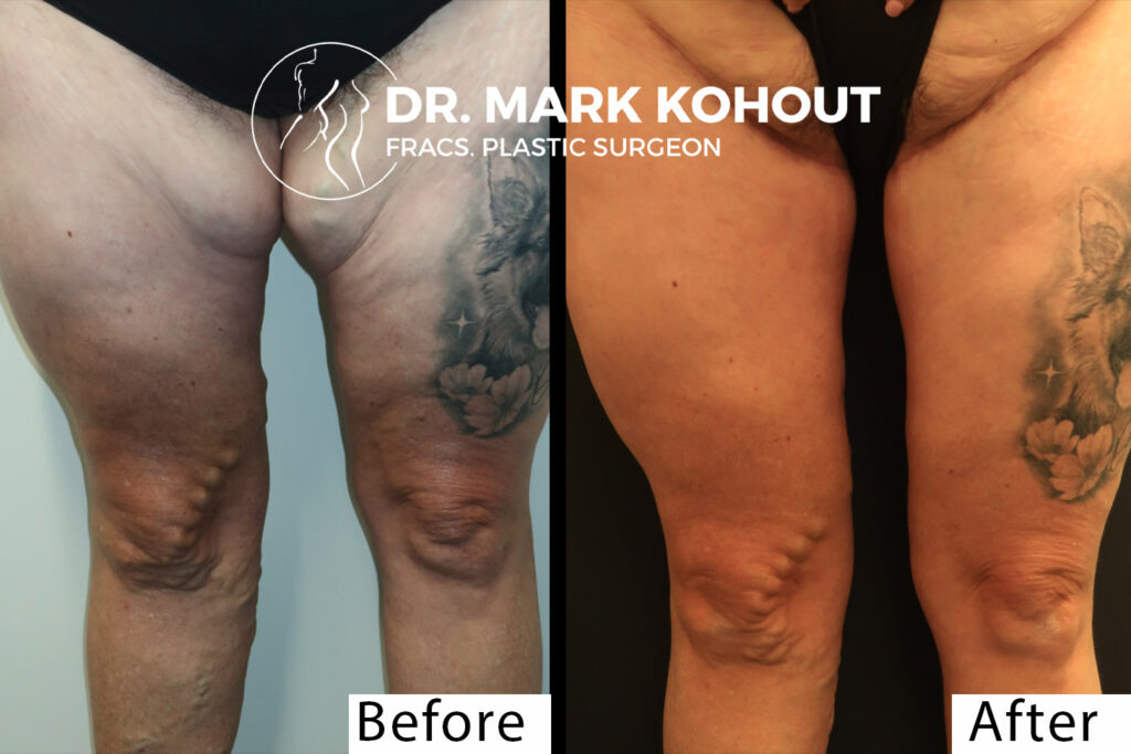 Thigh lift thigh reduction by Dr Kohout 1042