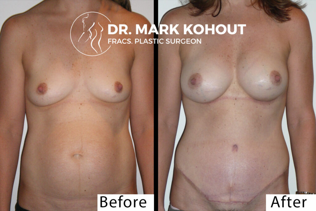 Abdominoplasty Tummy tuck Breast lift Mastopexy by Dr Kohout 1045