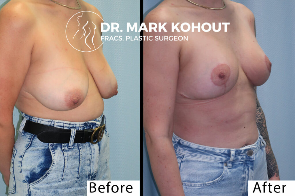 Abdominoplasty and Breast lift Mastopexy Before and After Photo by Dr.Kohout – 2001
