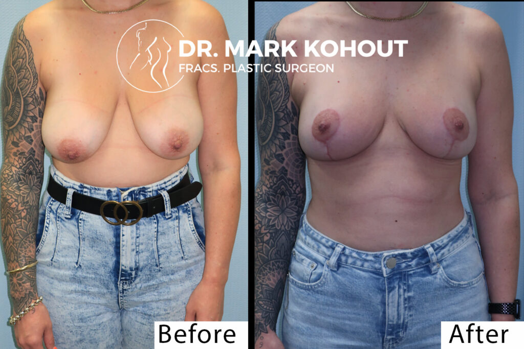 Breast lift Mastopexy by Dr Kohout 2001