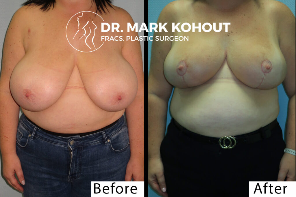 2004—Breast Reduction by Dr Kohout—front