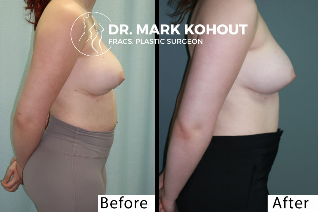 Waterfall Deformity With Breast Revision