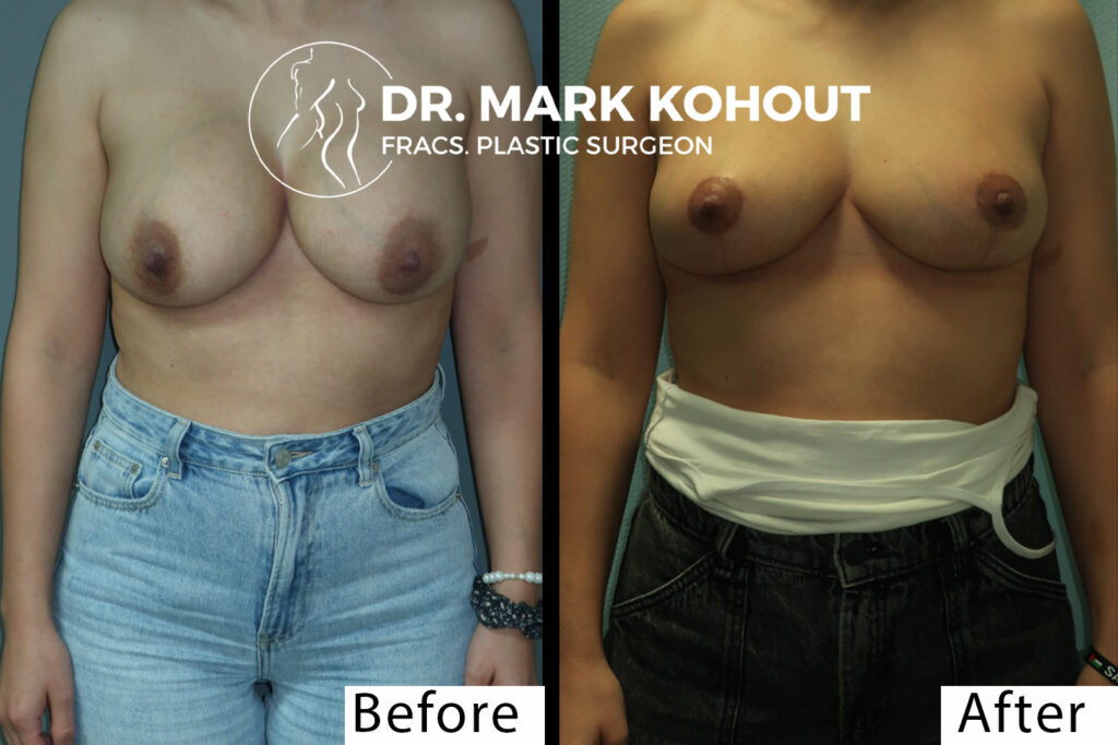 Waterfall Deformity With Breast Revision