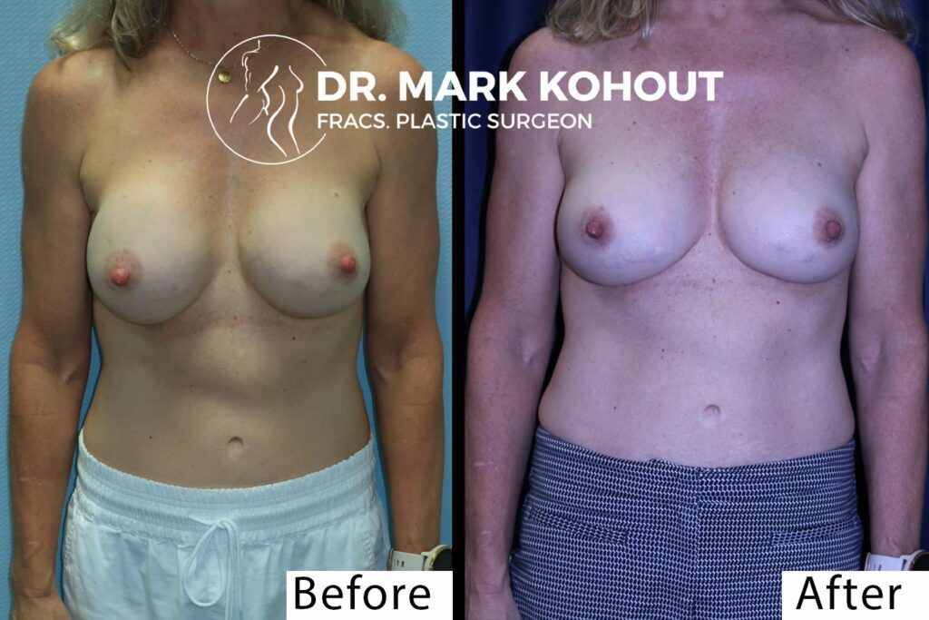 Waterfall Deformity With Breast Revision