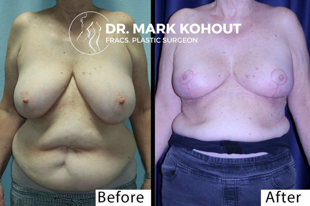 Breast reduction by Dr Kohout 2038