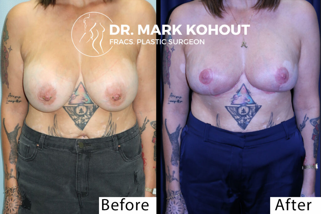 Breast Implant Exchange and Breast Revision - Exercise After Breast Removal