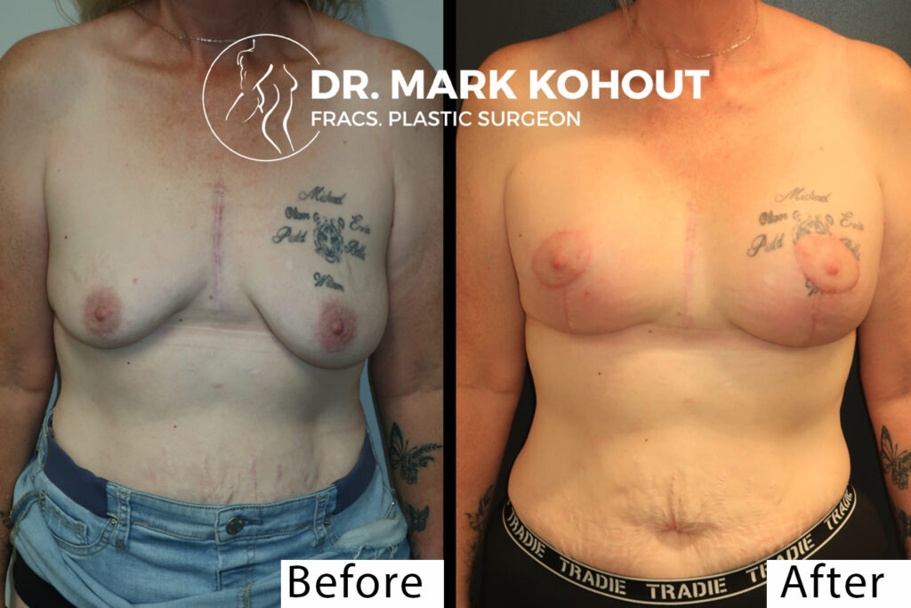 Exercise Timeline after Breast Augmentation