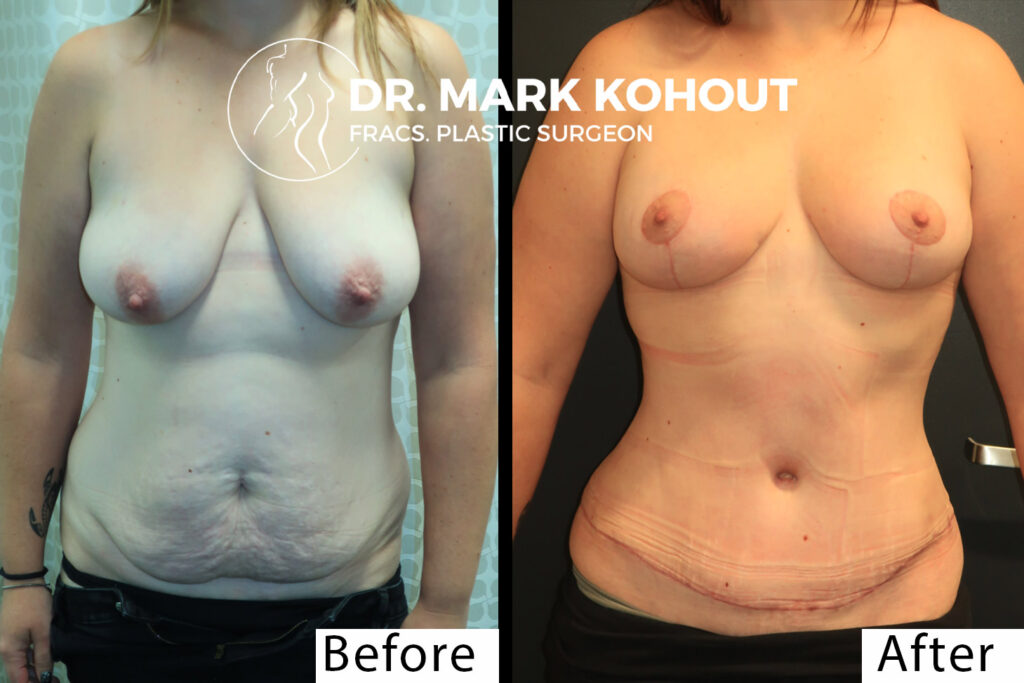 Abdominoplasty Tummy tuck Breast lift Mastopexy by Dr Kohout 2044
