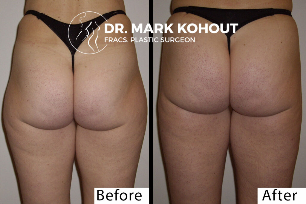 Liposuction of outer thighs Liposuction saddlebags by Dr Kohout 2049