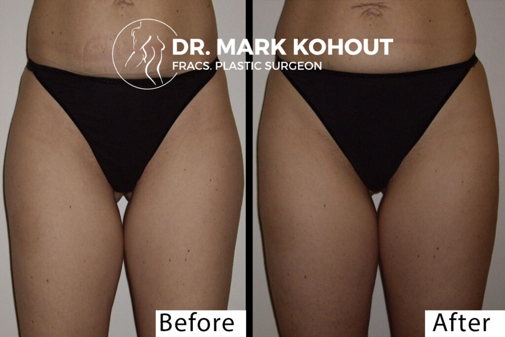 Liposuction of outer thighs Liposuction saddlebags by Dr Kohout 2049