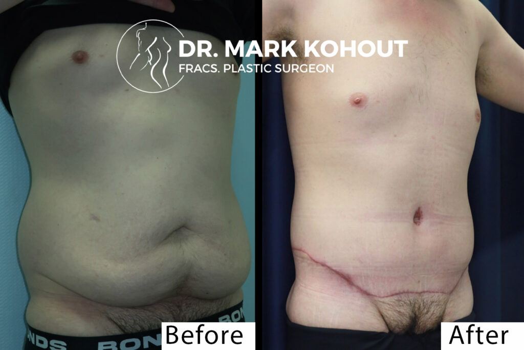 Body Lift - Belt Lipectomy Before and After Photo by Dr.Kohout - 2054