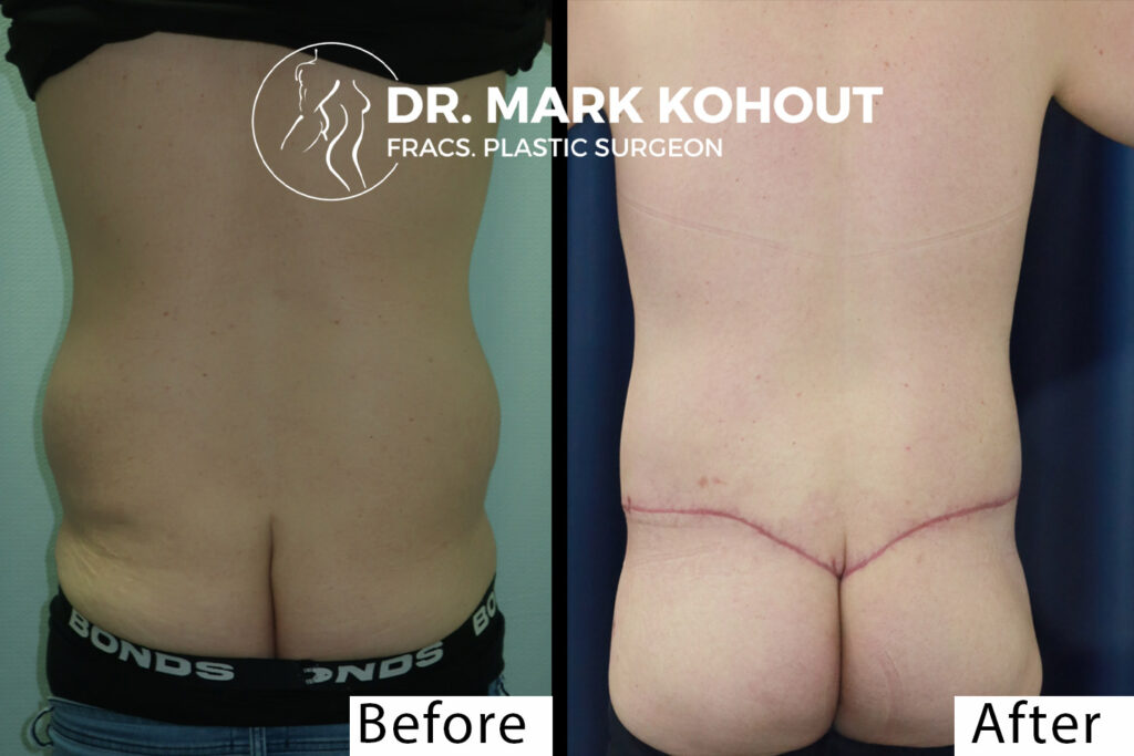 Body Lift - Belt Lipectomy Before and After Photo by Dr.Kohout - 2054