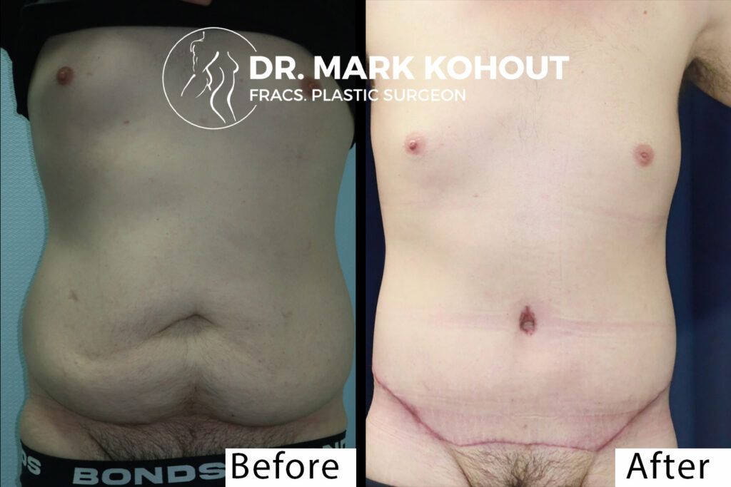 Body Lift - Belt Lipectomy Before and After Photo by Dr.Kohout - 2054