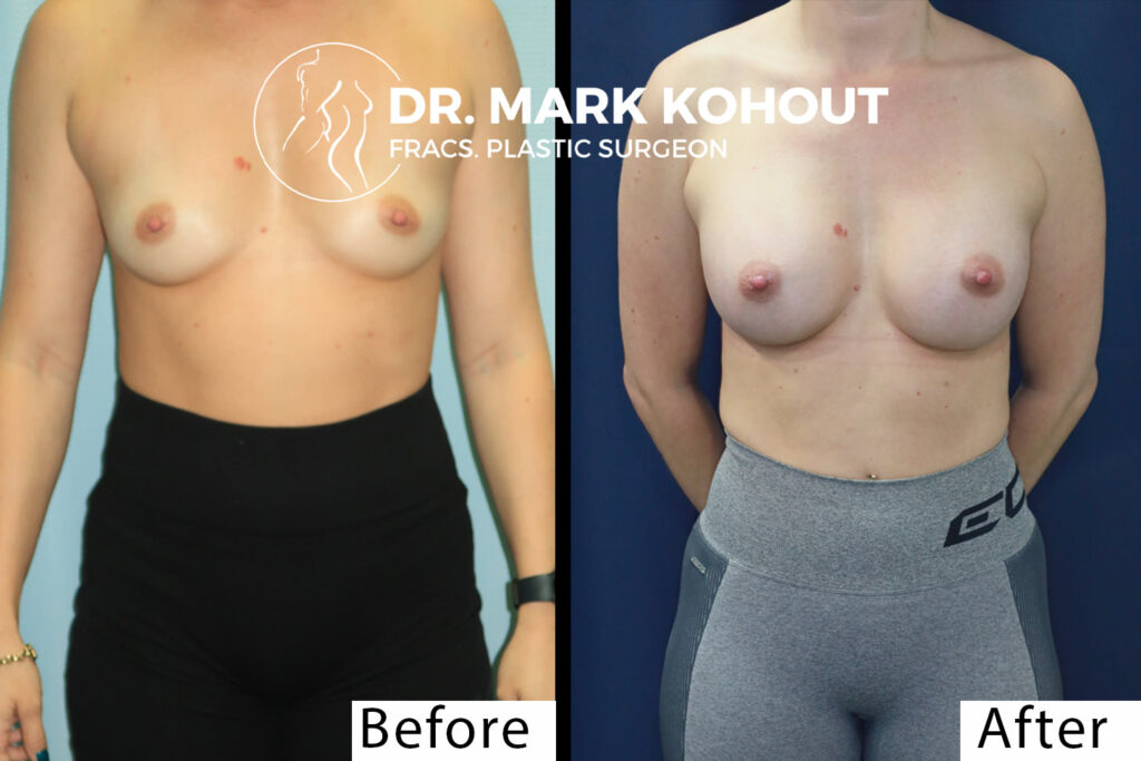 Exercise Timeline after Breast Augmentation