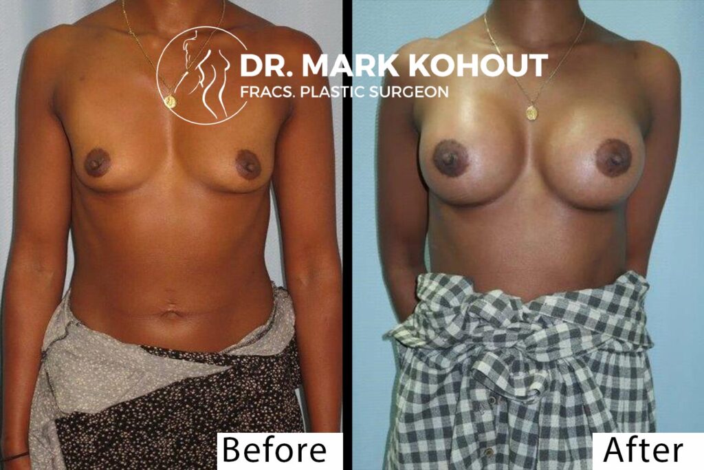 Breast augmentation with Lift faqs