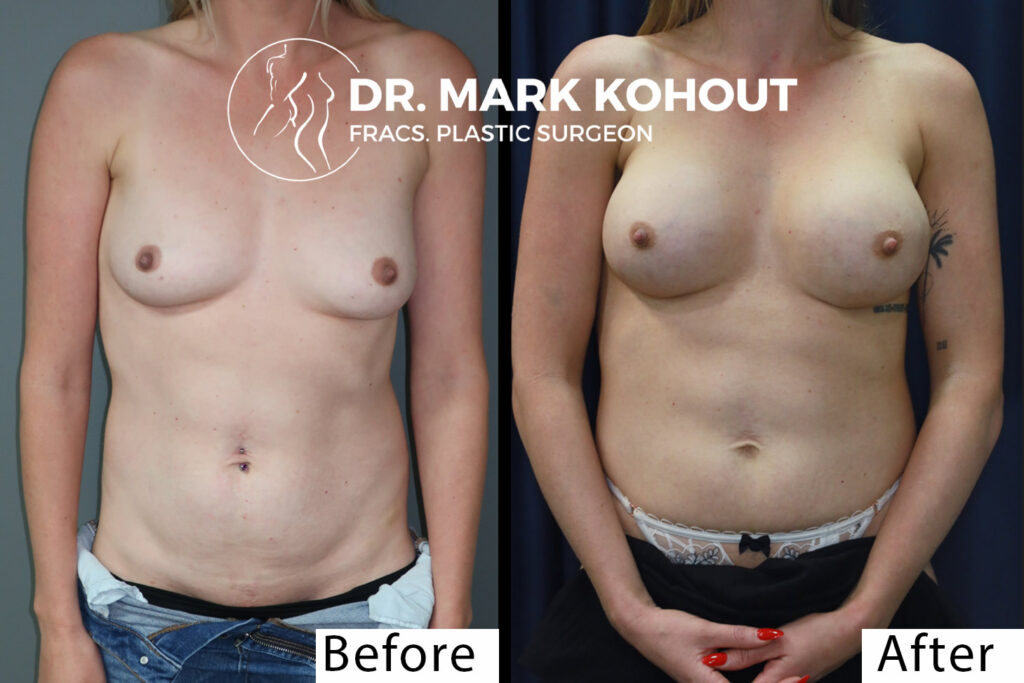 Breast augmentation with Lift faqs