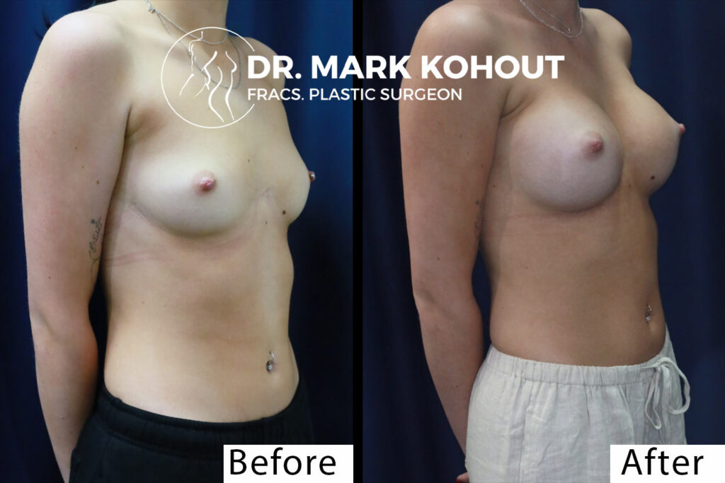 Exercise Timeline after Breast Augmentation