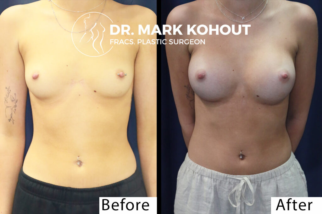 Breast Implant Surgery Before and After Images