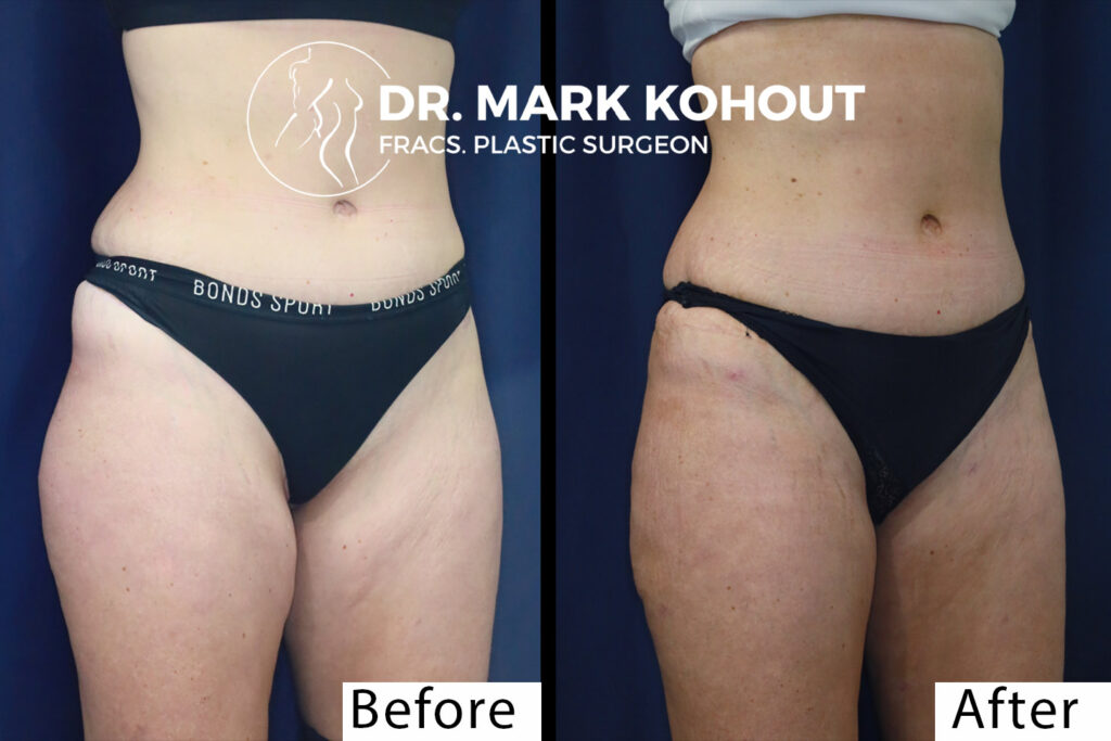 Liposuction to flanks an outer thighs by Dr Kohout 2074