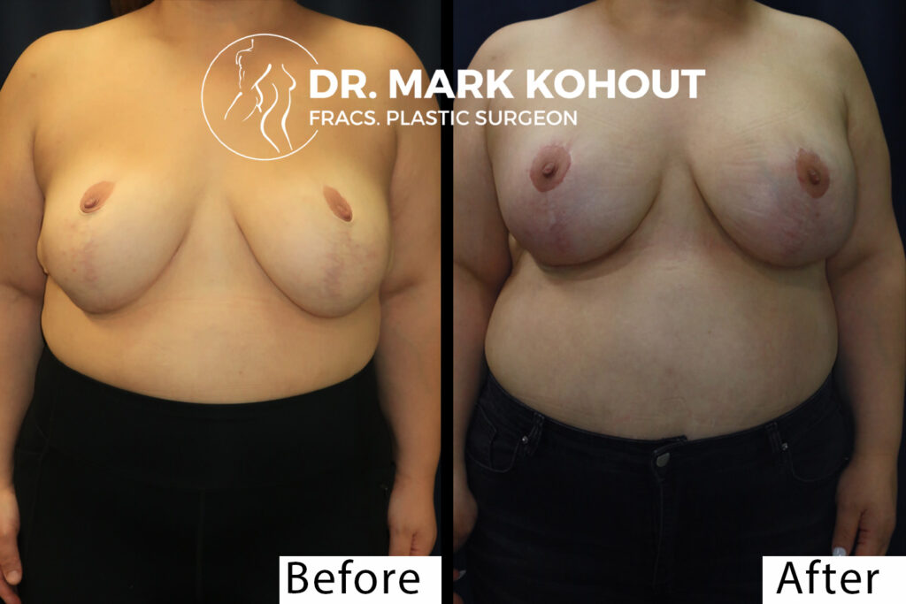 Breast Implant Exchange and Breast Revision - Exercise After Breast Removal