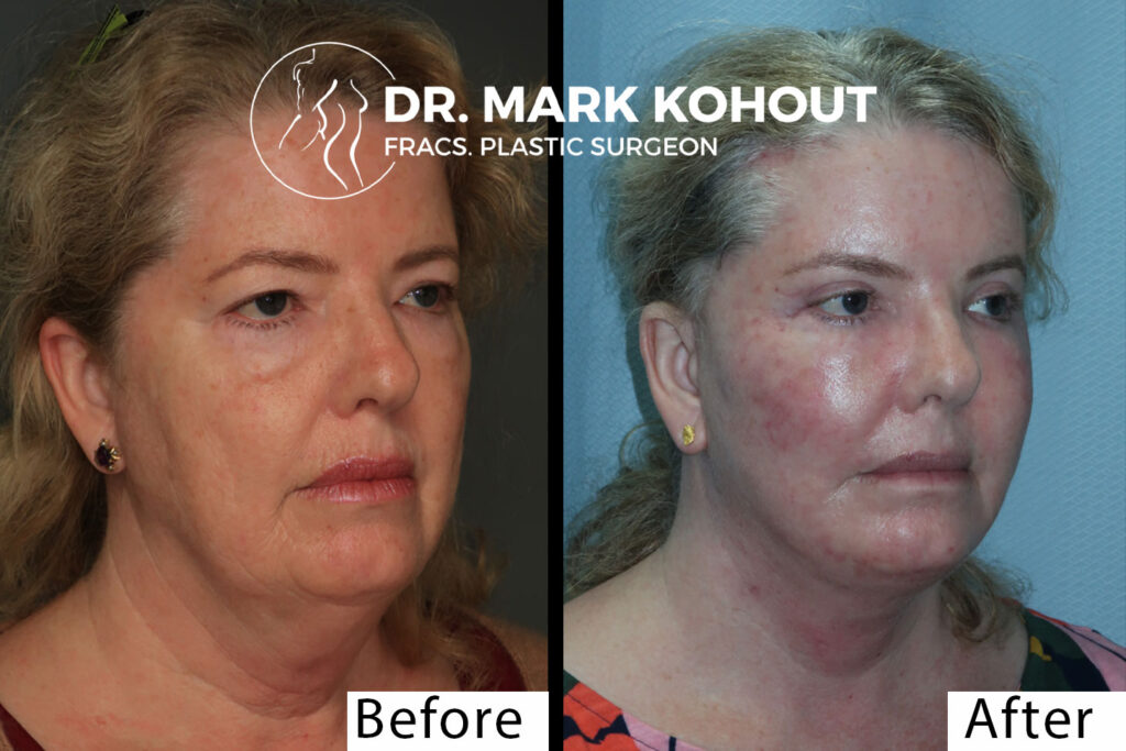 Facelift Cost Sydney