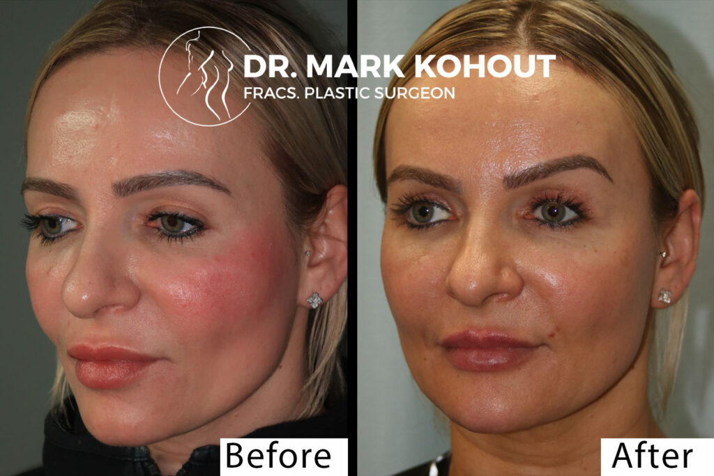 Blepharoplasty Medicare Cover
