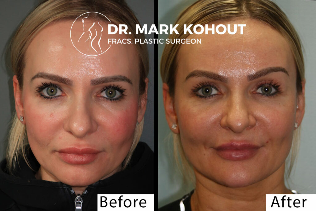Browlift and upper blepahroplasty eyelid reduction by Dr Kohout 3035