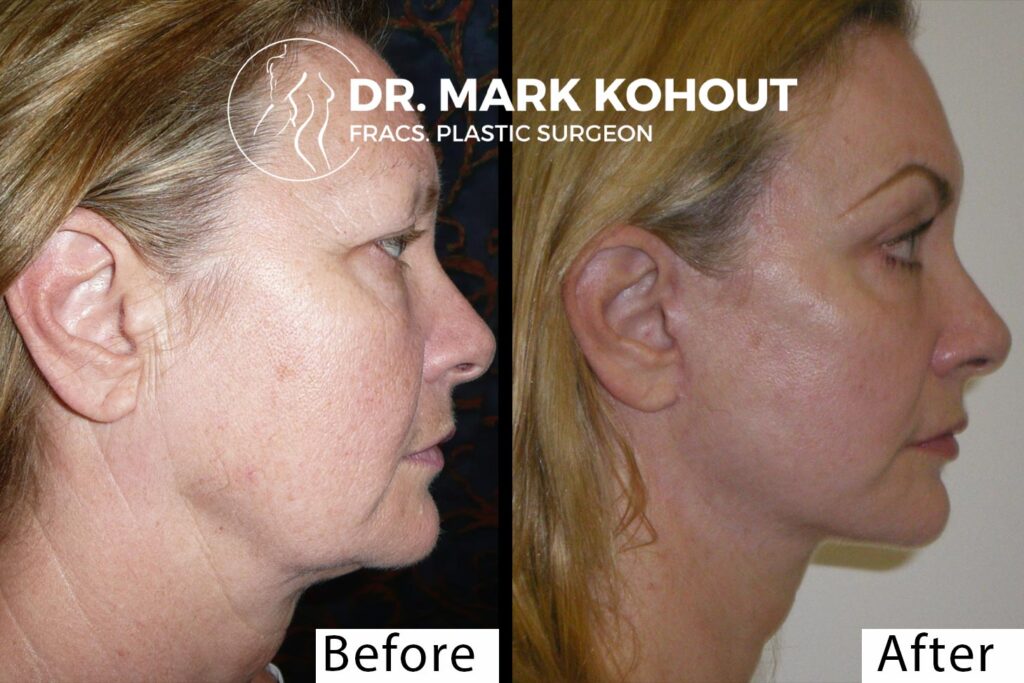 Facelift blepahroplasty and laser by Dr Kohout 3073