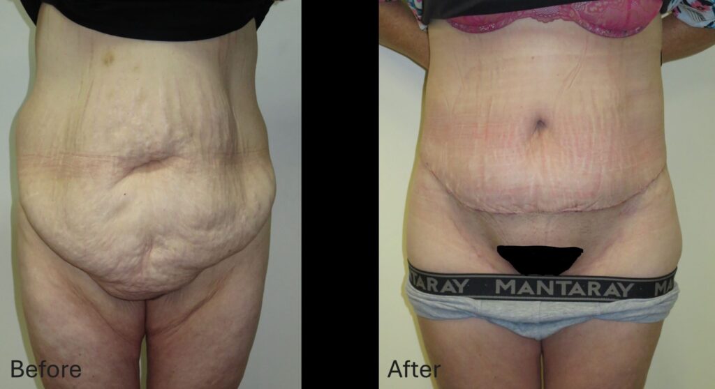 Abdominoplasty - diastasis recti