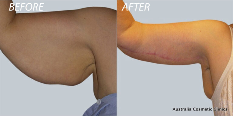 Arm Lift Before and After Photo Patient 4 - Dr Mark Kohout