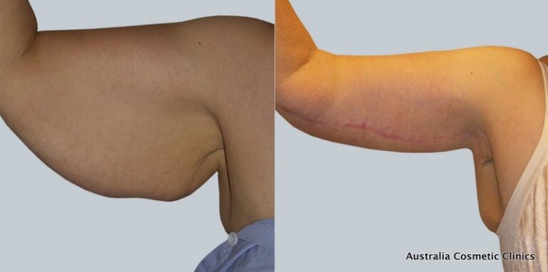Arm Reduction 2 14 from Acc - Dr Mark Kohout