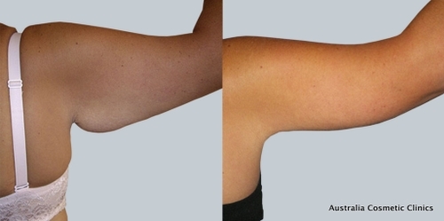 Arm Reduction 3 12 From Acc - Dr Mark Kohout