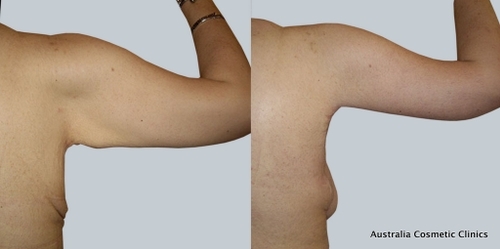 Arm Reduction 4 9 From Acc - Dr Mark Kohout