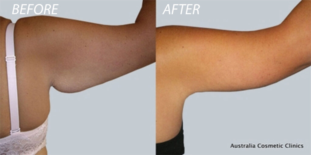 Arm Lift Before and After Photo Patient 2