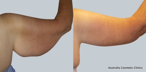 Arm Reduction 5 6 From ACC - Dr Mark Kohout