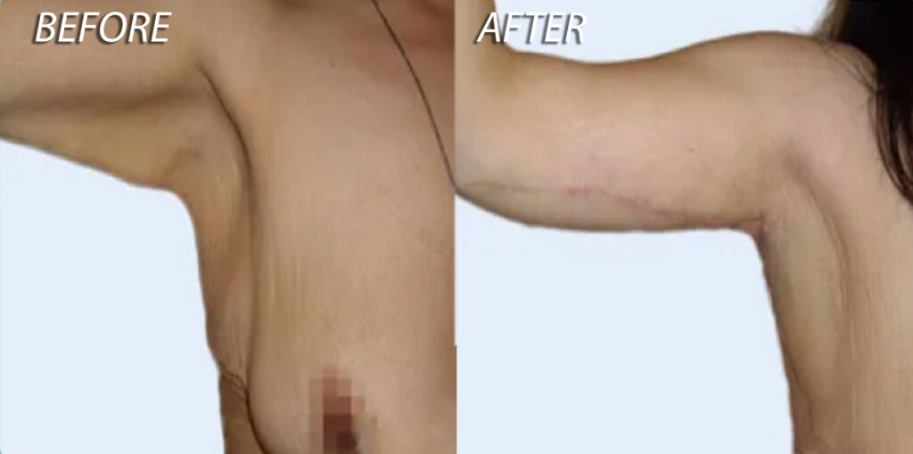 Arm Lift Before and After Photo Patient 5 - Dr Mark Kohout