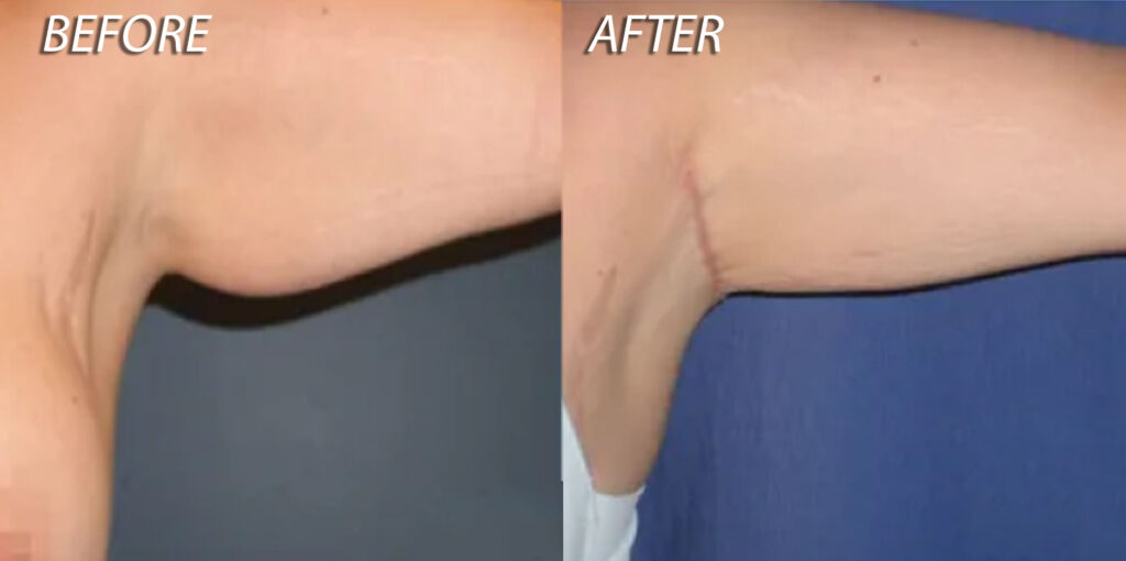 FAQs About Arm Lift - Before and After