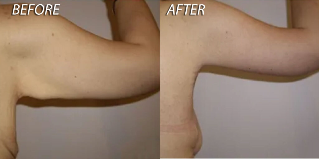 Arm Lift Before and After Photo Patient 7