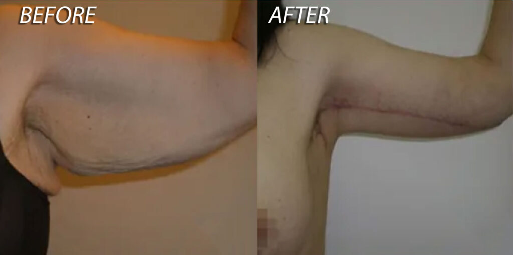 Arm Lift Before and After Photo Patient 6 - Dr Mark Kohout