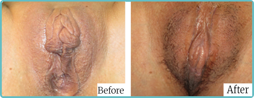 labioplasty 02 - Dr Mark Kohout
