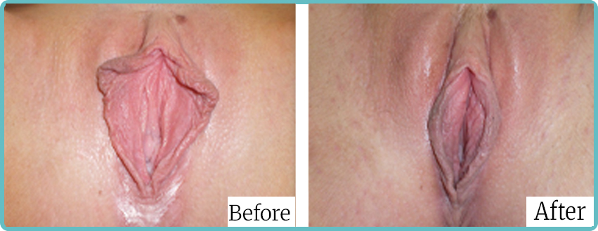 labioplasty 07 - Dr Mark Kohout