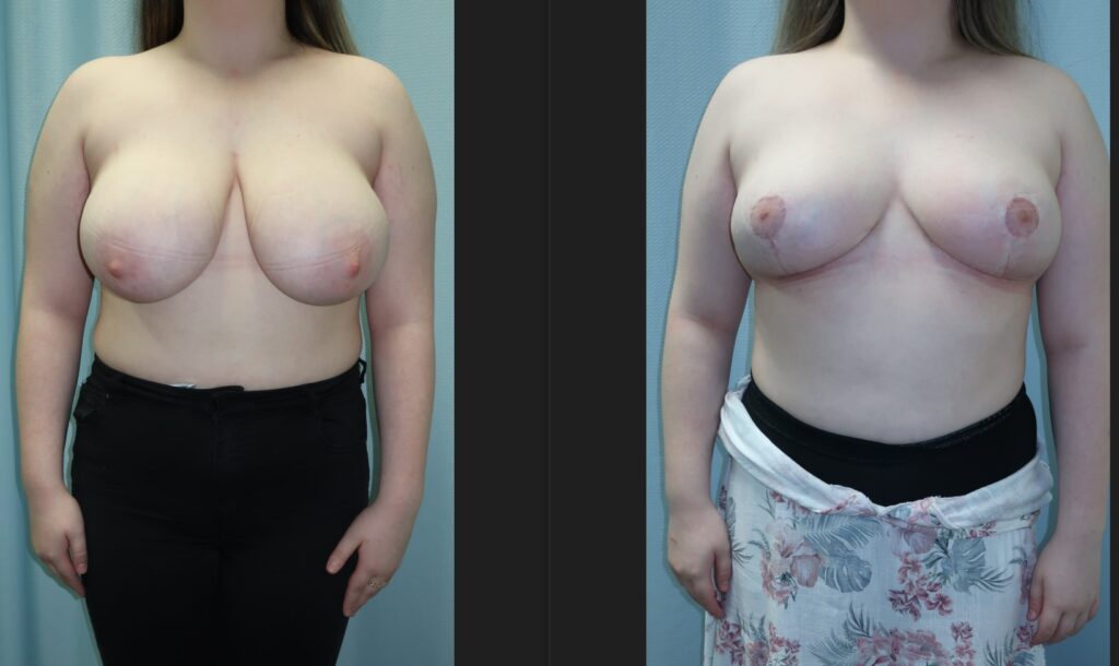 Healing and Recovery After Breast Reduction Surgery