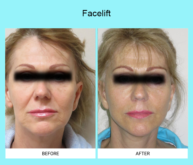 Facelift-Patient-11-front