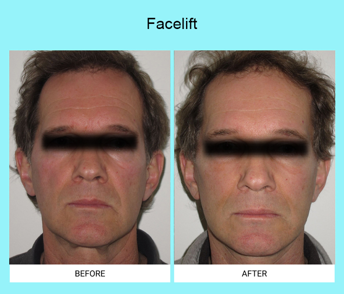 Facelift-Patient-13-front
