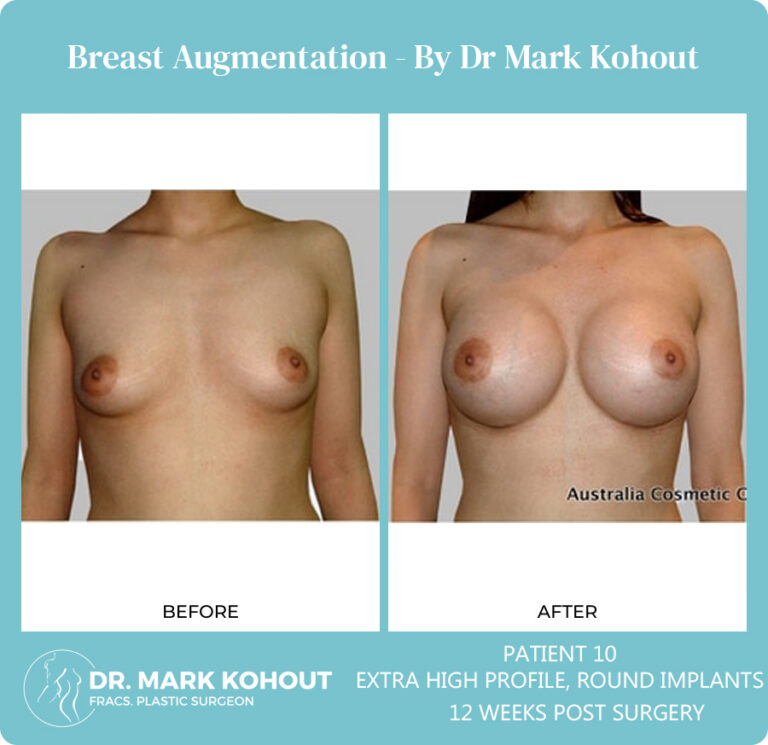 Breast Augmentation Patient