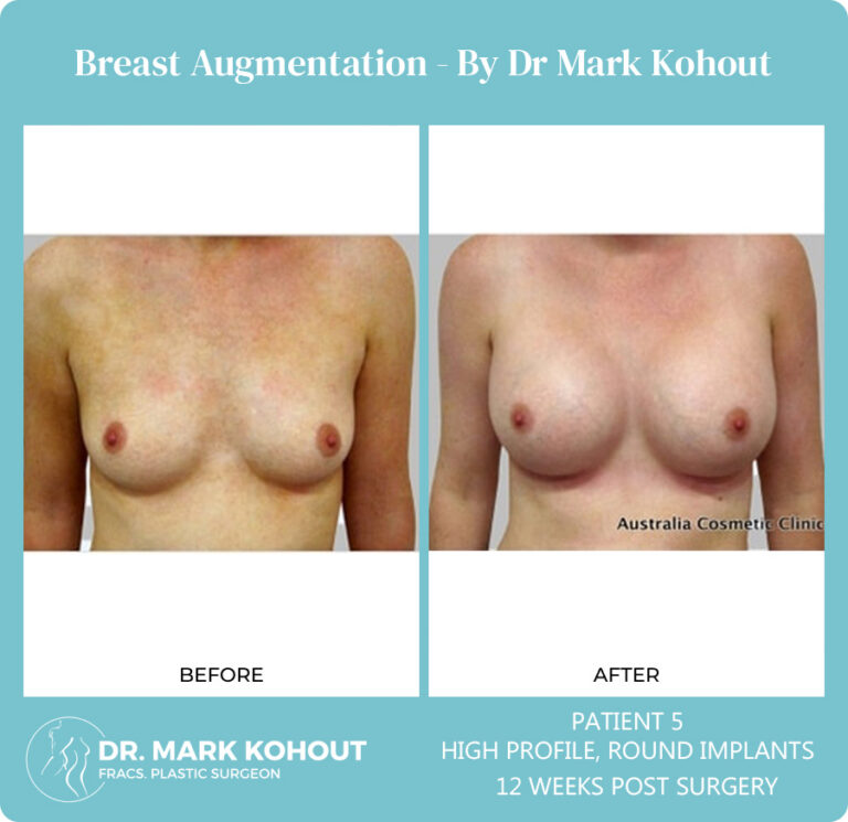 Breast Augmentation Patient