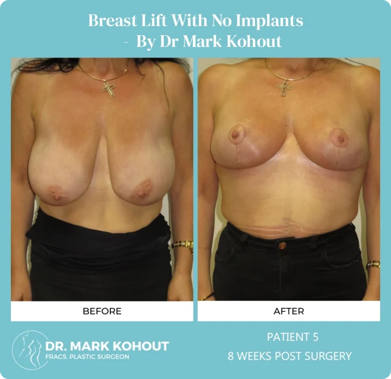 Breastlift Patient 5 front - Dr Mark Kohout