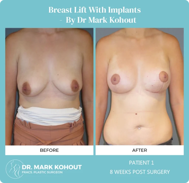 Breastlift with Implant Patient 1 front - Dr Mark Kohout
