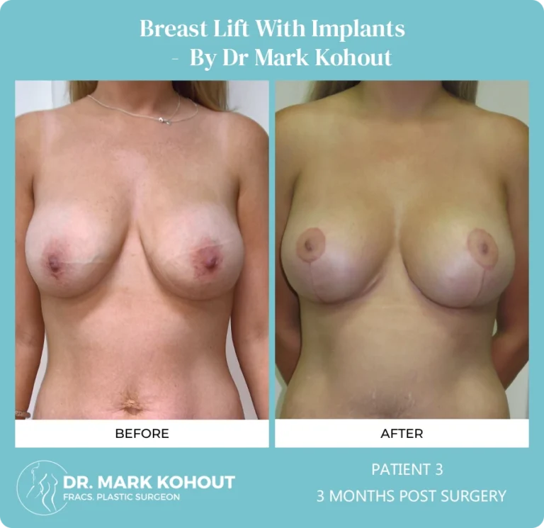 Breastlift with Implant Patient 3 front - Dr Mark Kohout
