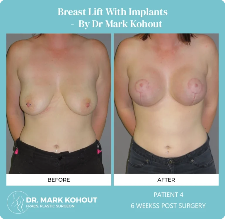 Breastlift with Implant Patient 4 front - Dr Mark Kohout